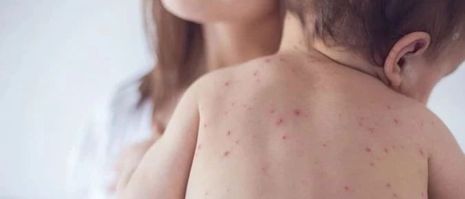 太严重了!新西兰感染麻疹人数突破1000人!请尽快接种疫苗! - 得居房产资讯